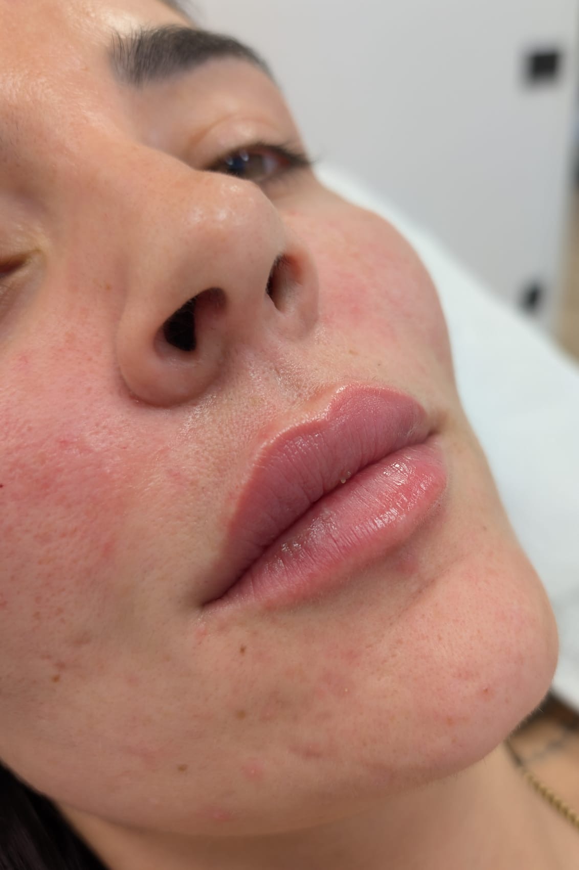Carboxiterapia 92b0fb99 ae36 482e 9767 d506d6769d72