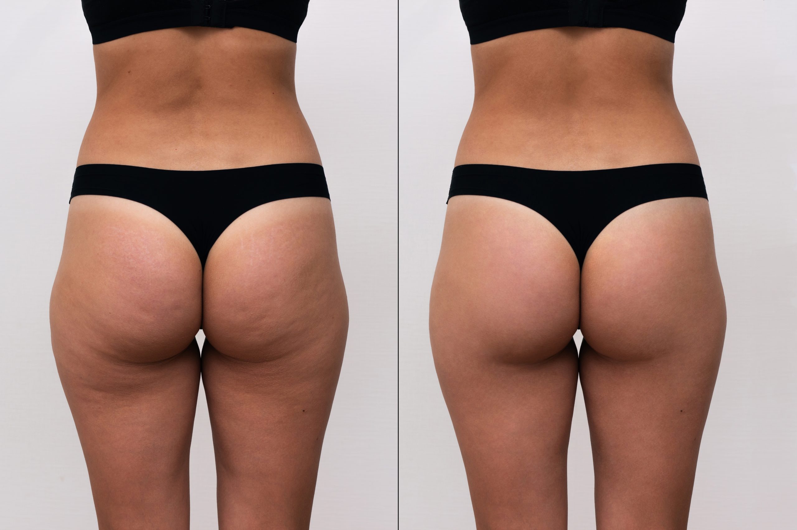 female buttocks with cellulite before after anti cellulite procedures sports massage