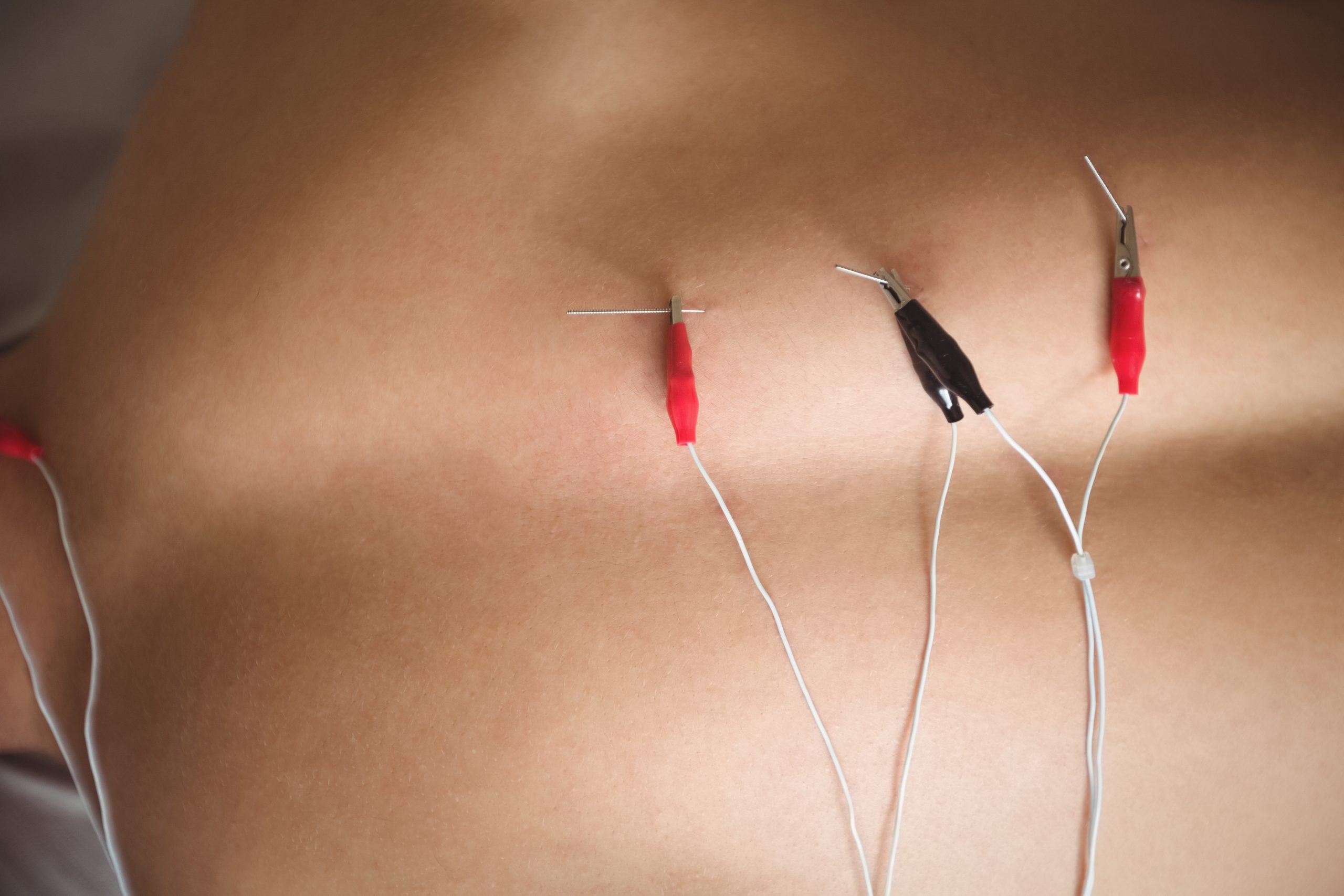 close up of patient getting electro dry needling on his back in clinic
