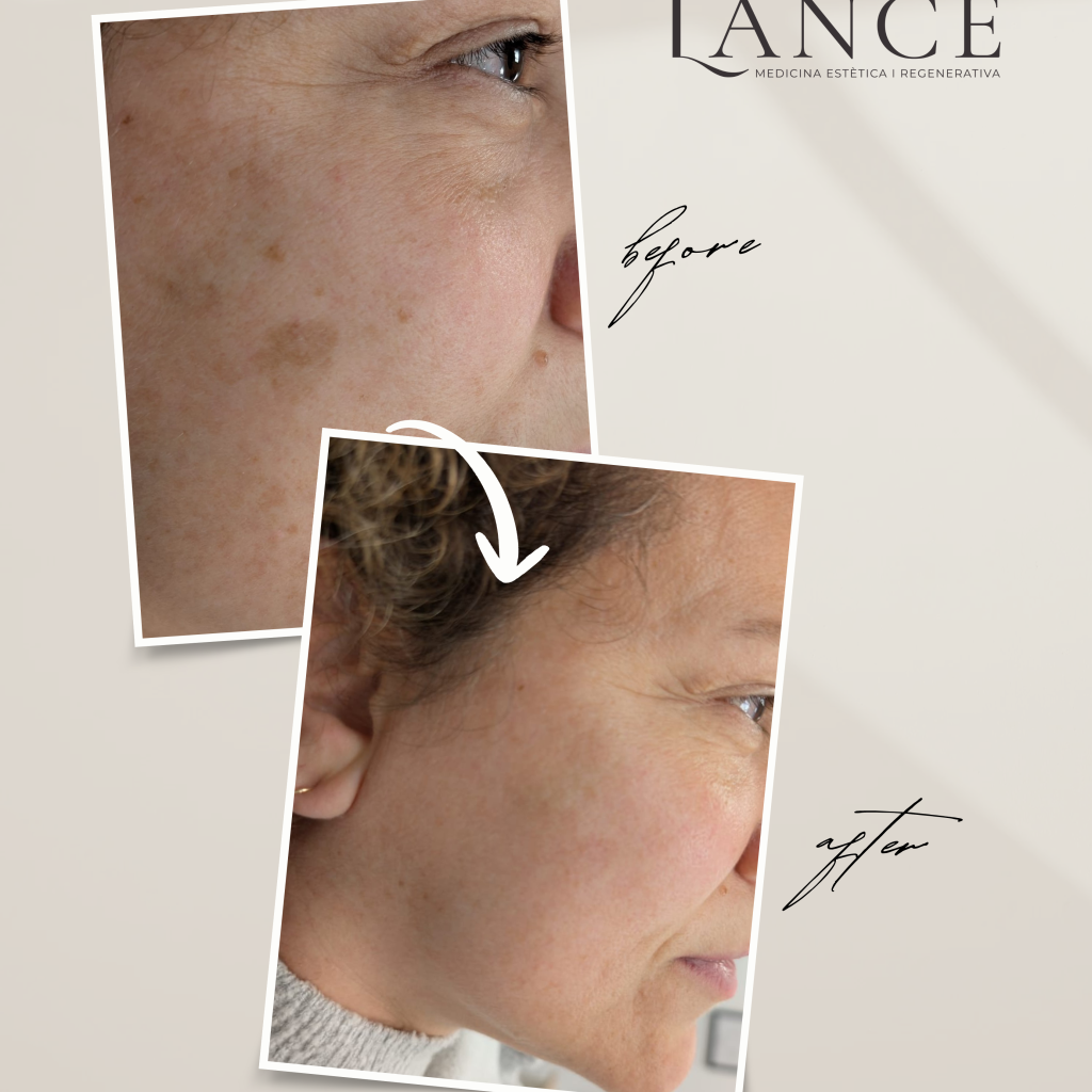gray minimalist before and after skincare instagram story (post de instagram (45))
