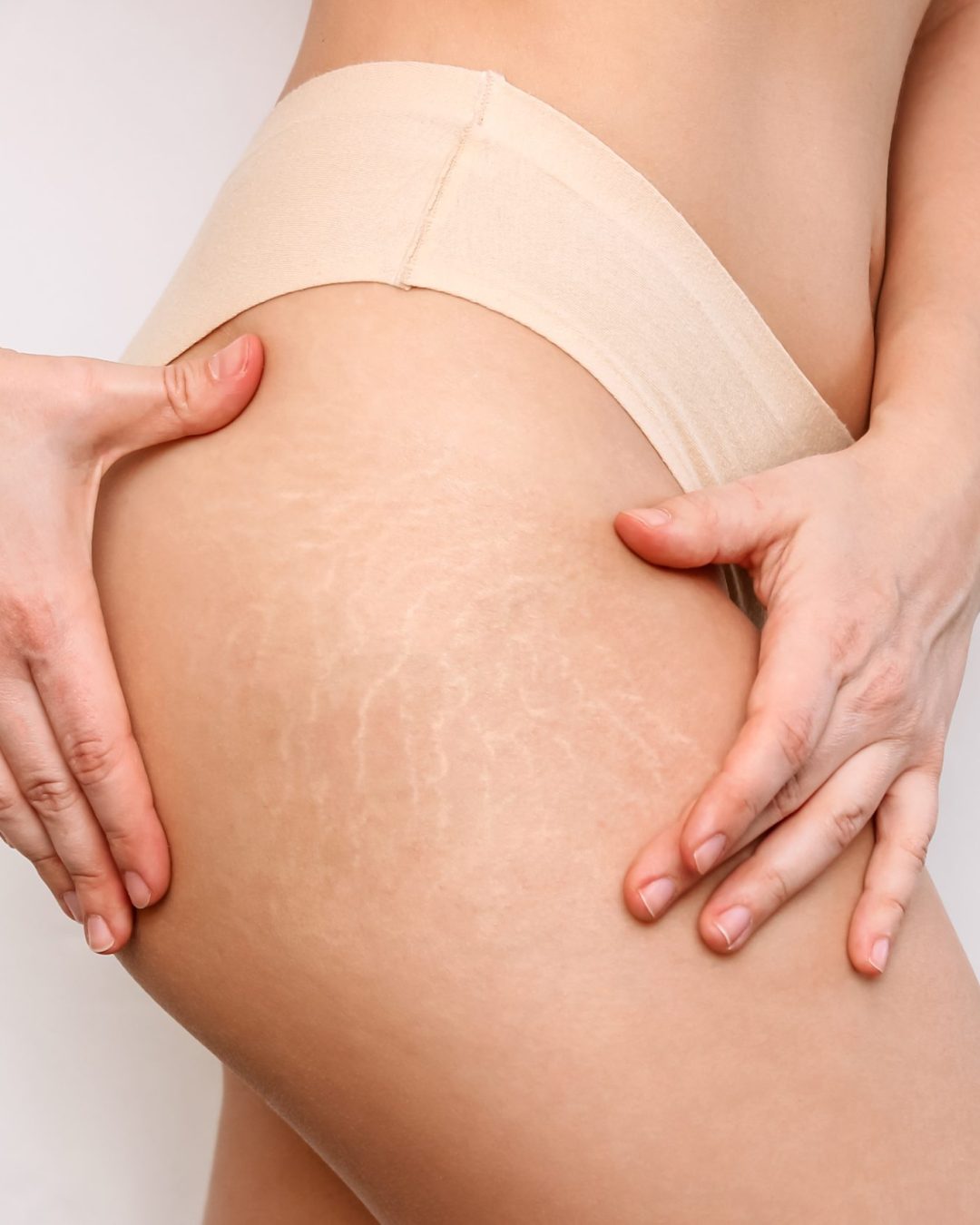 closeup female thigh with white stretch marks from sharp weight loss weight gain changes