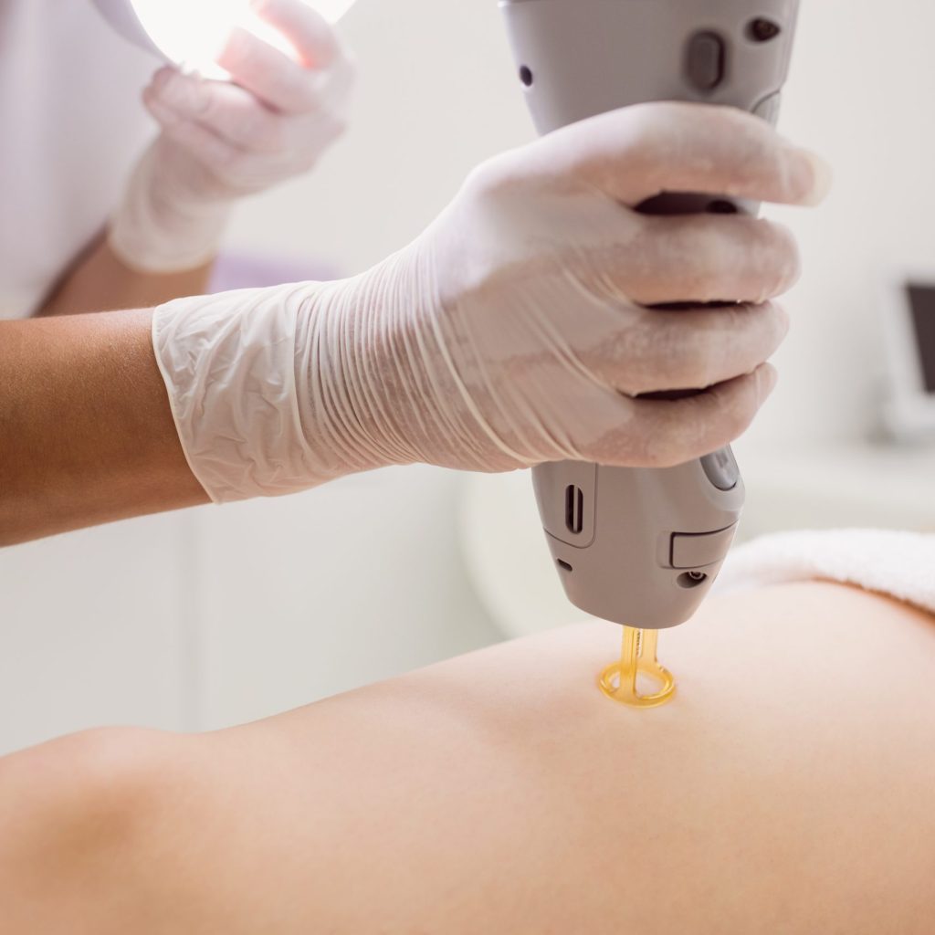 close up of doctor performing laser hair removal on female patient skin in clinic