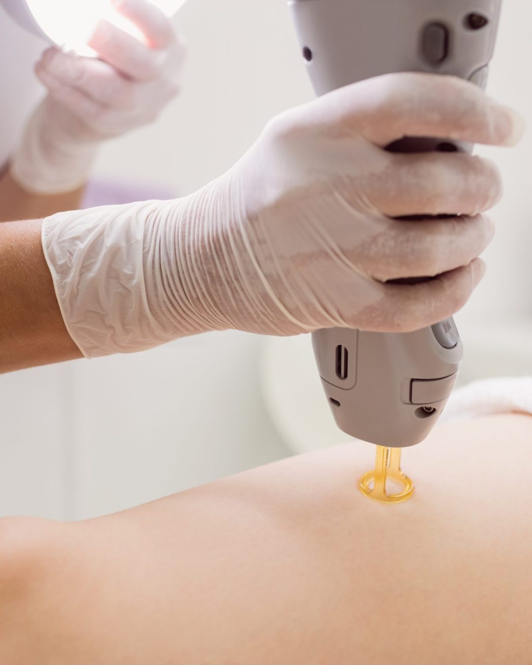 close up of doctor performing laser hair removal on female patient skin in clinic