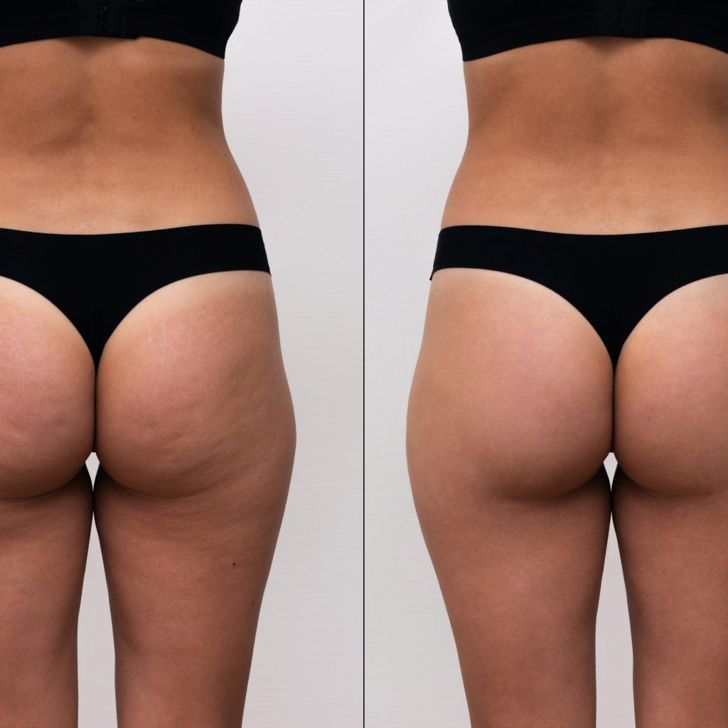 female buttocks with cellulite before after anti cellulite procedures sports massage
